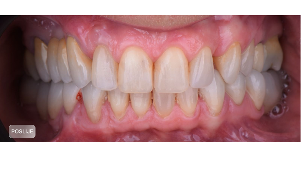 parodontologija, upala gingive, recesija zubnog mesa, liječenje desni, upala desni, krvarenje desni