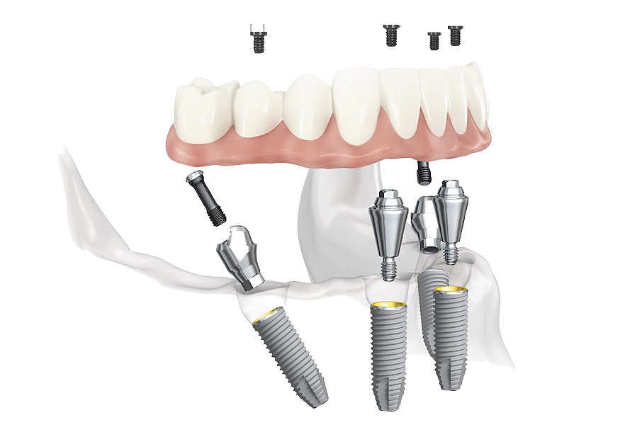 all on 4 by nobel, ugradnja implantata zagreb, najkvalitetniji zubni implantati