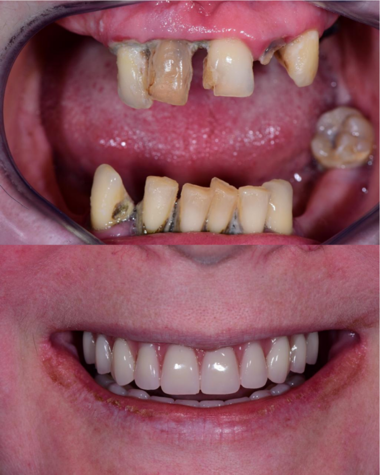 rezultati ugradnje implantata, all on 4, all on 4, rezultati ugradnje implantata, rezultati all on 4 ugradnje, vgradnja vsadki, zagreb, cijena all on 4, cijena ugradnje implanrtata, najkvalirtetniji zubni implantati