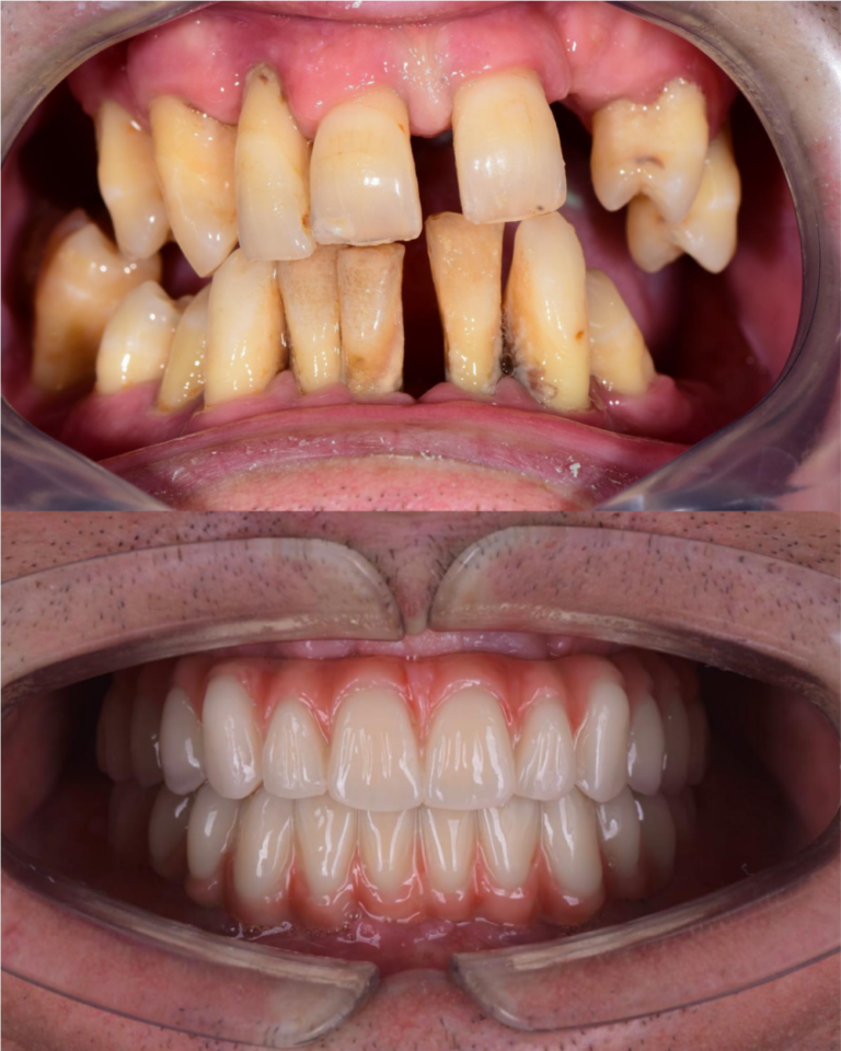 all on 4, all-on-4, rezultati ugradnje implantata, rezultati all on 4 ugradnje, vgradnja vsadki, zagreb, cijena all on 4, cijena ugradnje implanrtata, najkvalirtetniji zubni implantati