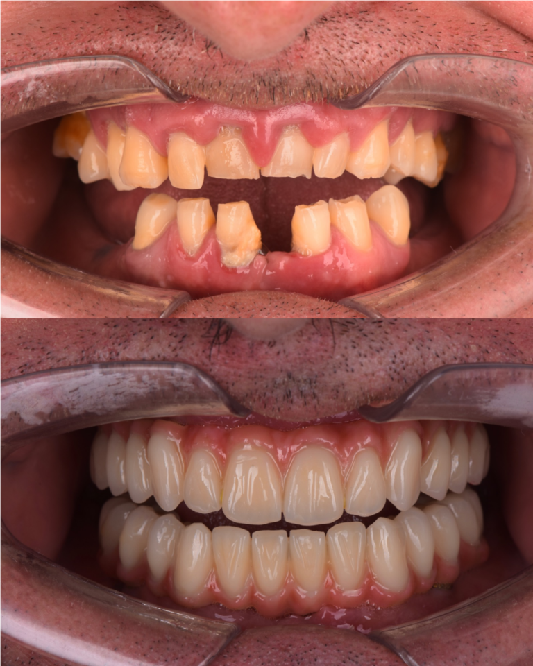 all on 4, all on 4, rezultati ugradnje implantata, rezultati all on 4 ugradnje, vgradnja vsadki, zagreb, cijena all on 4, cijena ugradnje implanrtata, najkvalirtetniji zubni implantati