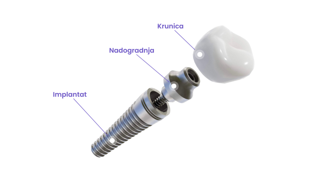 sastav zubnog implantata, zubni implantat, ugradnja zubnog implantata
