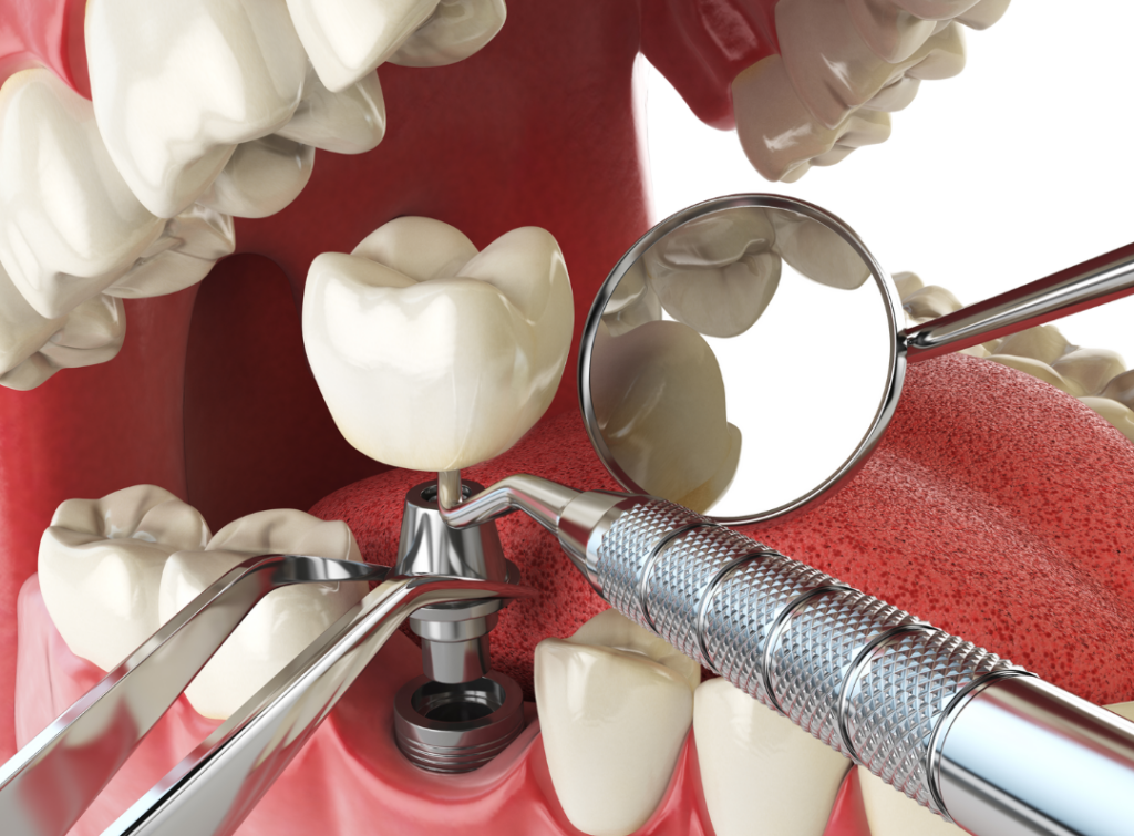 Zubni implantat Zubna protetika Stomatologija Oralna kirurgija Zubni kirurg Implantologija Zubna krunica Zubni most Cijena zubnog implantata Dentalna klinika, dr. Marko Krmpotić ugradnja implantata, zubni implantati, nobel implantati, straumman implantati, šarafi zubi, umjetni zub, zubni implant, zubni implantat cijena, cijena zubnog implantata