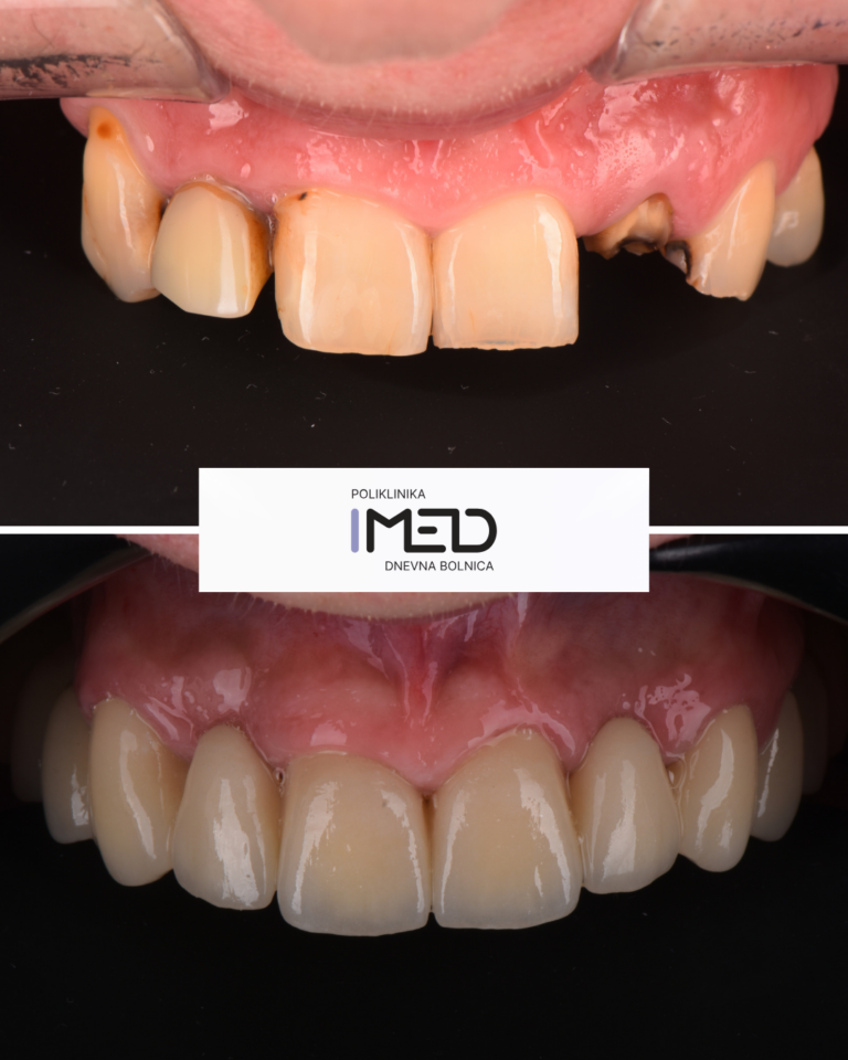 prije poslije zubni implnatati