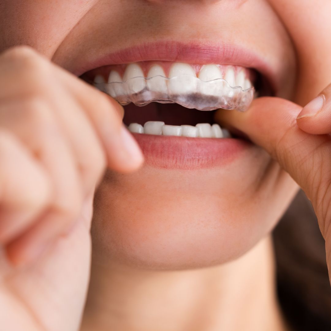 Prikaz terapijske udlage kojom se liječi bruksizam.