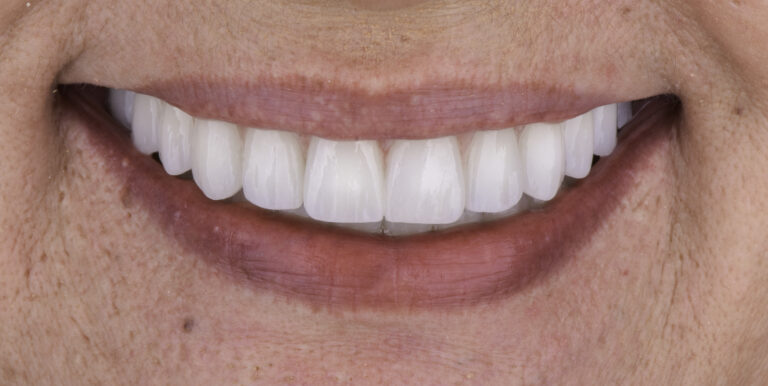 Prikaz zubnih ljuskica.