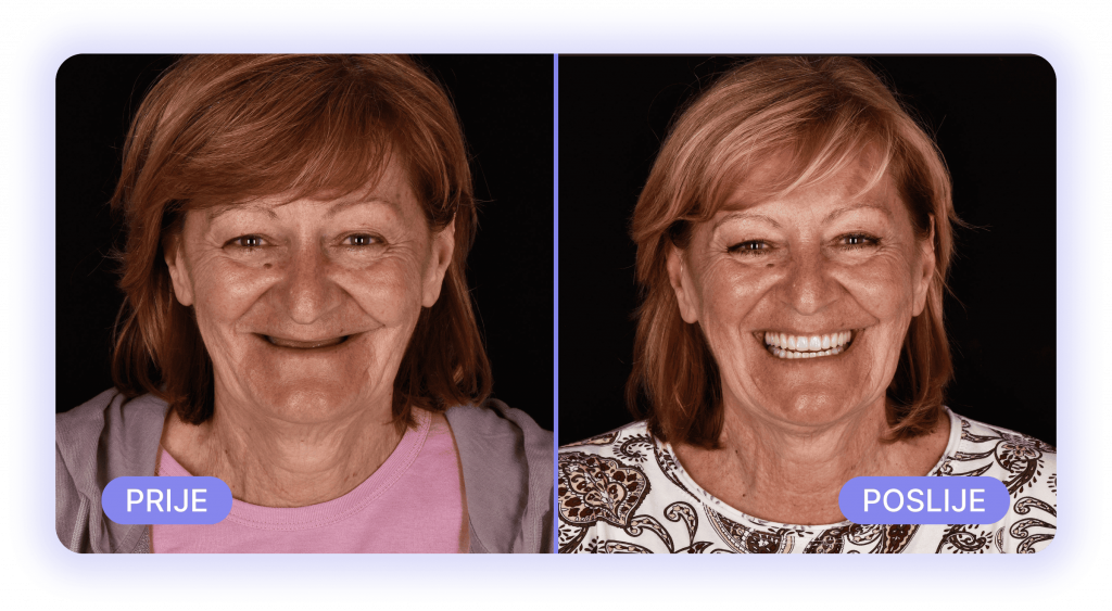 all on 4 - prije poslije rezultati