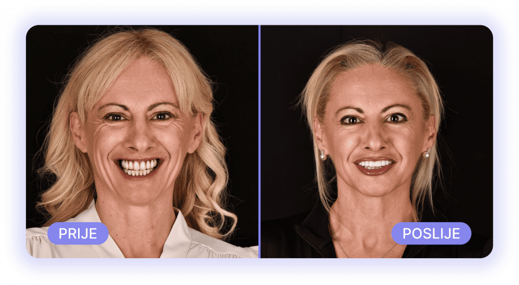 all on 4 - prije poslije rezultati