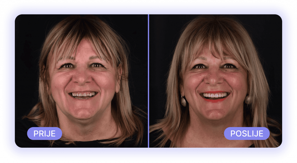 all on 4 - prije poslije rezultati