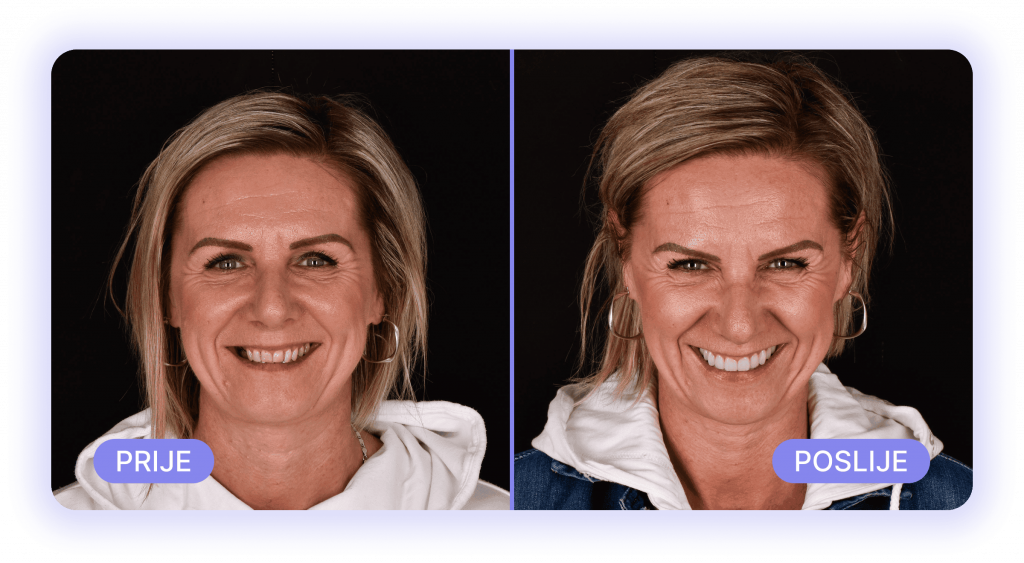 all on 4 - prije poslije rezultati