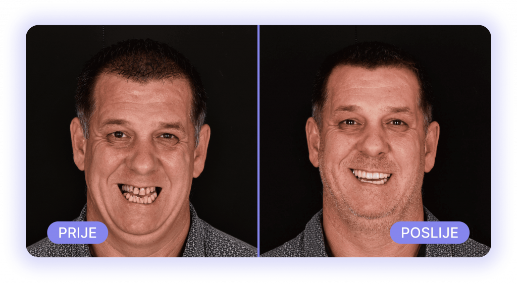 all on 4 - prije poslije rezultati