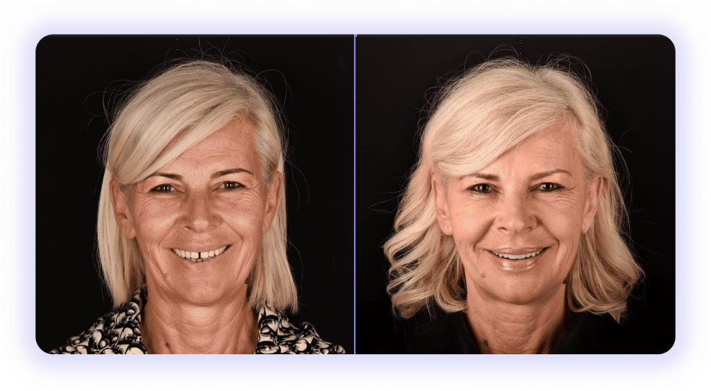 all on 4 - prije poslije rezultati