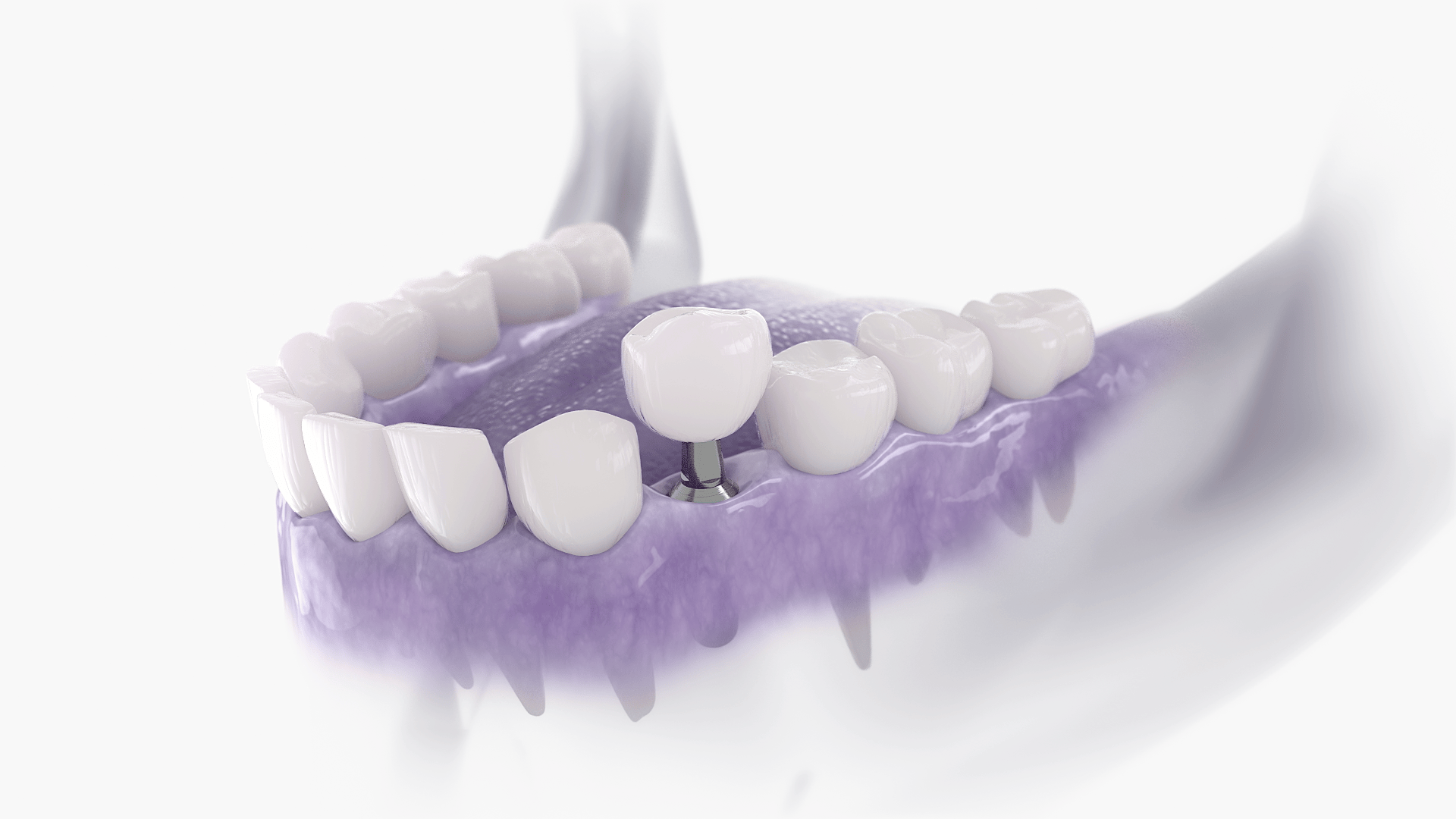 zubni implantati cijena