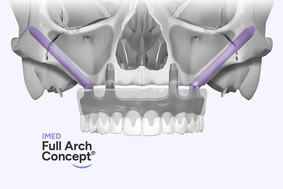 zygoma implantati implanti